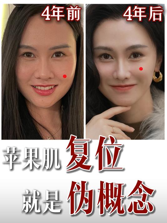 手机版苹果肌杭州大秀辛芷蕾苹果肌膨胀-第2张图片-太平洋在线下载